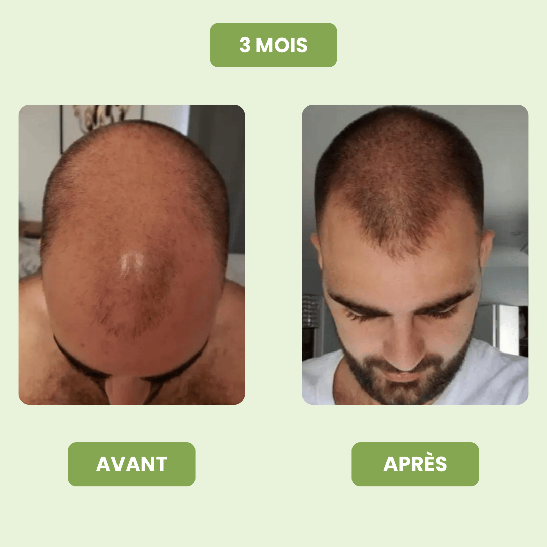 Sérum de Croissance Capillaire pour Hommes