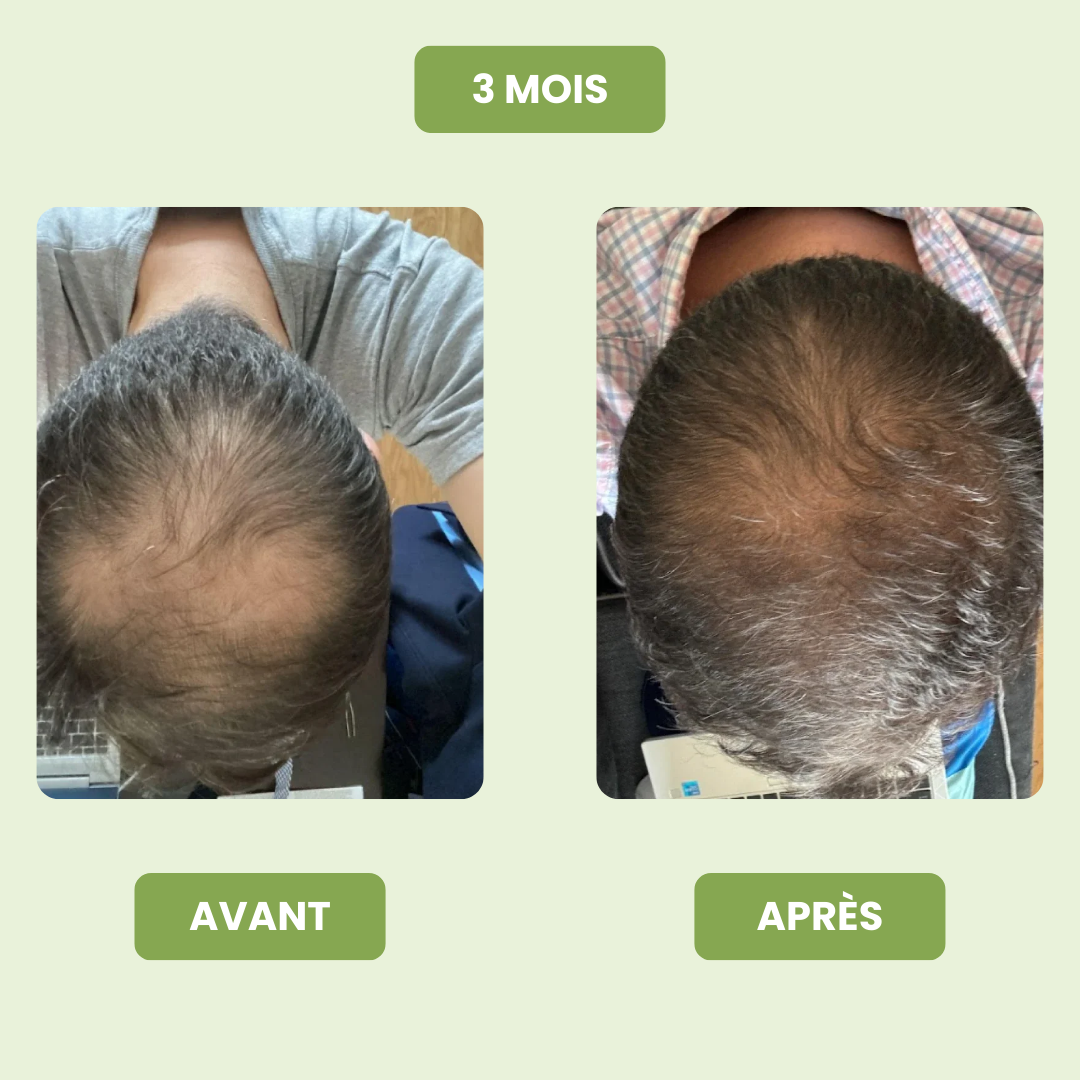 Sérum de Croissance Capillaire pour Hommes