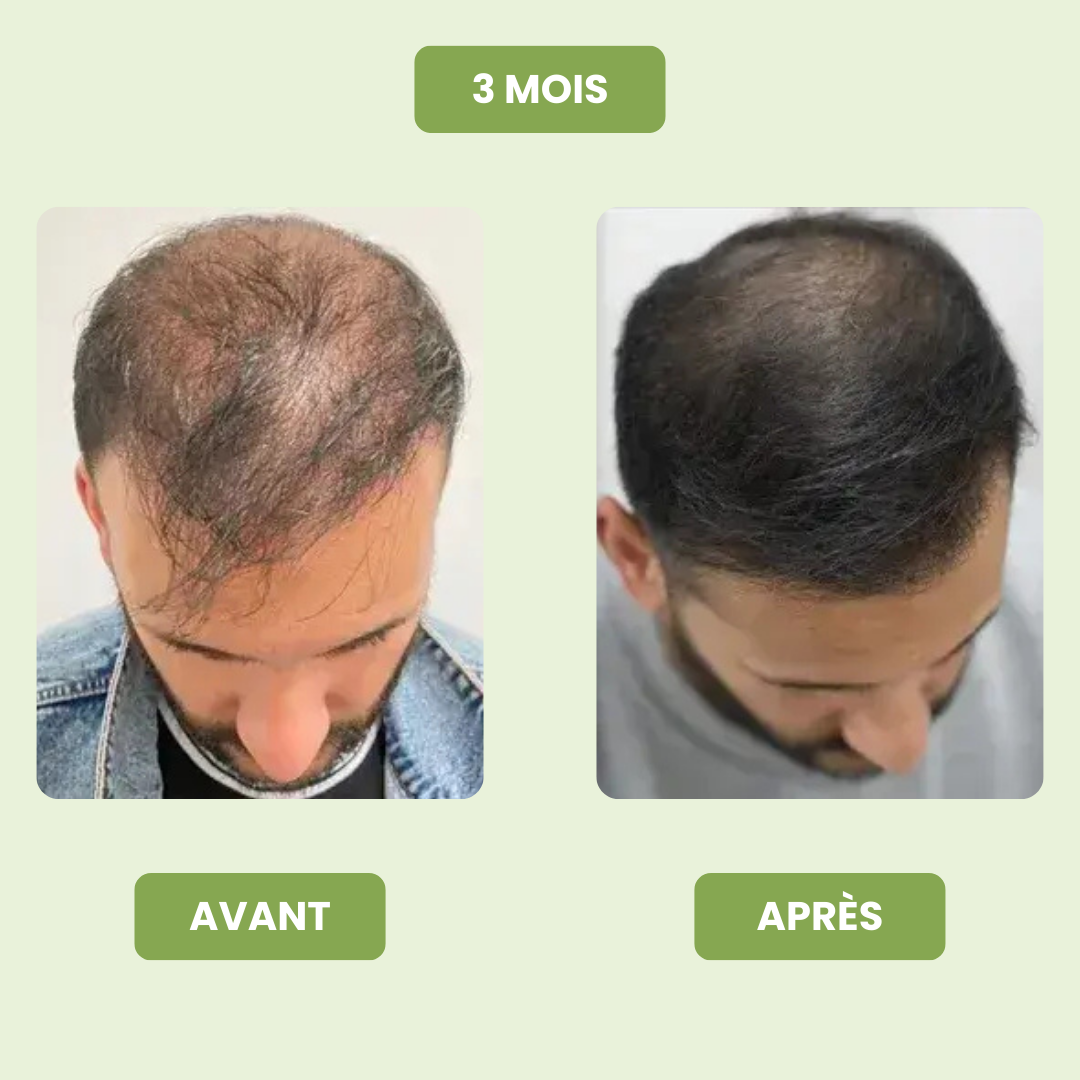 Sérum de Croissance Capillaire pour Hommes
