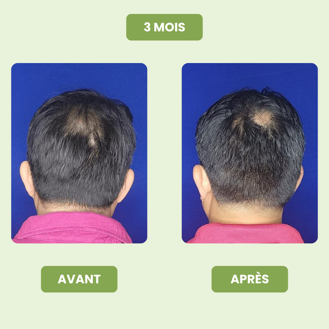 Sérum de Croissance Capillaire pour Hommes