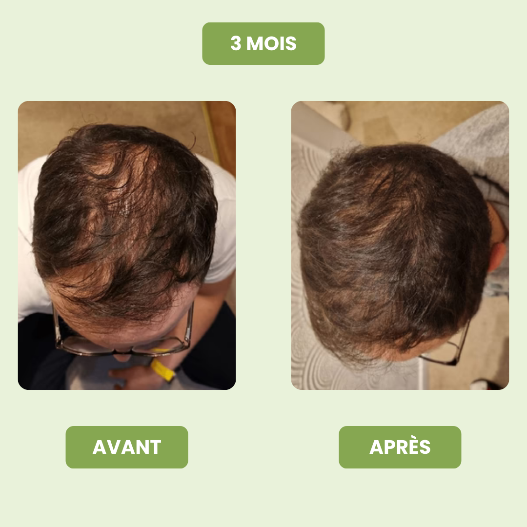 Sérum de Croissance Capillaire pour Hommes